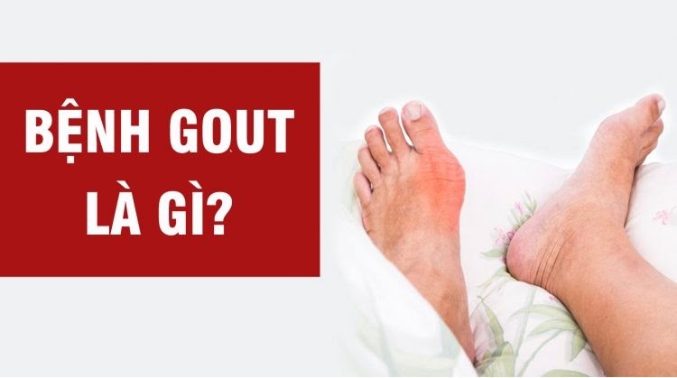 Nhận biết sớm dấu hiệu bệnh gout giúp điều trị hiệu quả hơn