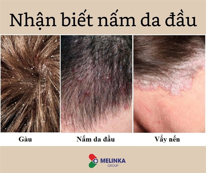 Nấm da đầu là gì? Nguyên nhân và cách điều trị nấm da đầu
