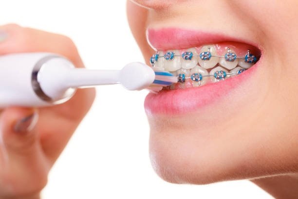 Vì sao phải vệ sinh răng miệng khi niềng răng?