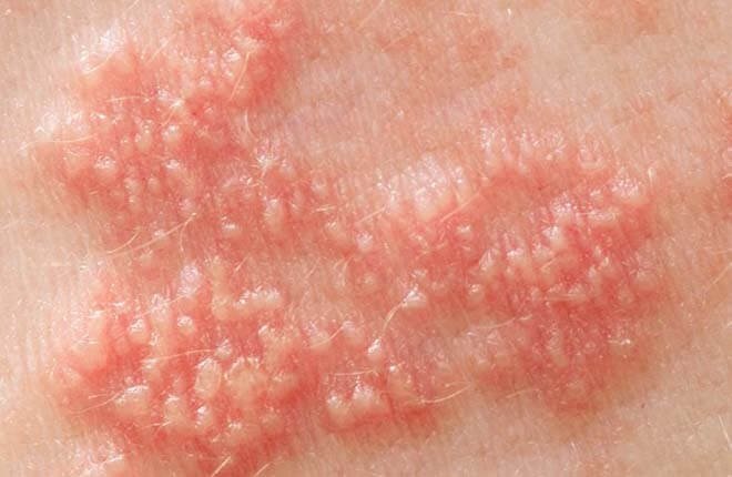 Nhiễm herpes dễ bị nhầm lẫn với bệnh đường sinh dục nào?